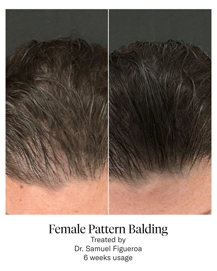 Female pattern balding - before and after