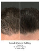 Female pattern balding - before and after