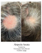 Alopecia areata - before and after