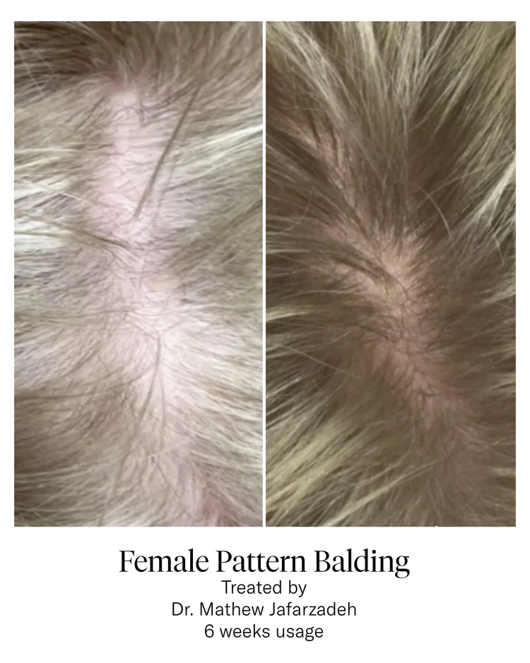 female pattern balding