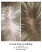 female pattern balding
