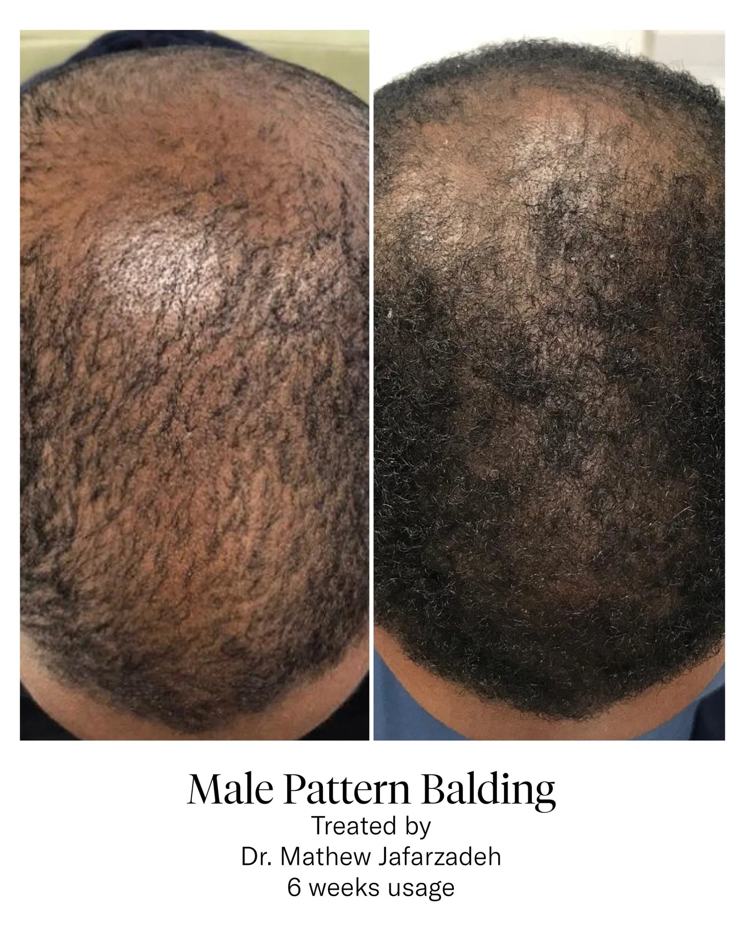 male pattern balding - before and after