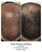 male pattern balding - before and after